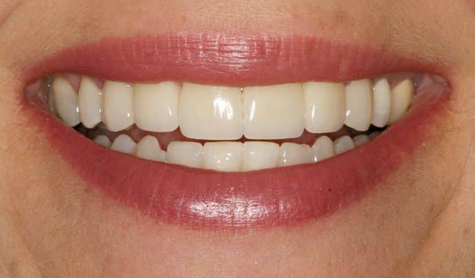 20 crowns  veneers (including hotel and transfers)